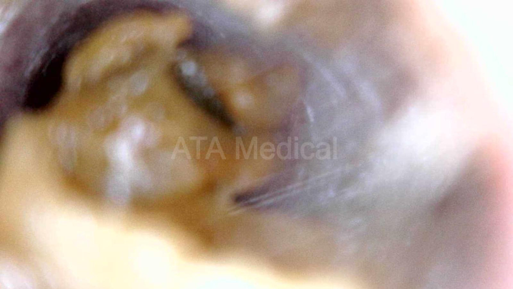 Close-up otoscopic view of a large mass of impacted ear wax lodged in a patient's ear canal