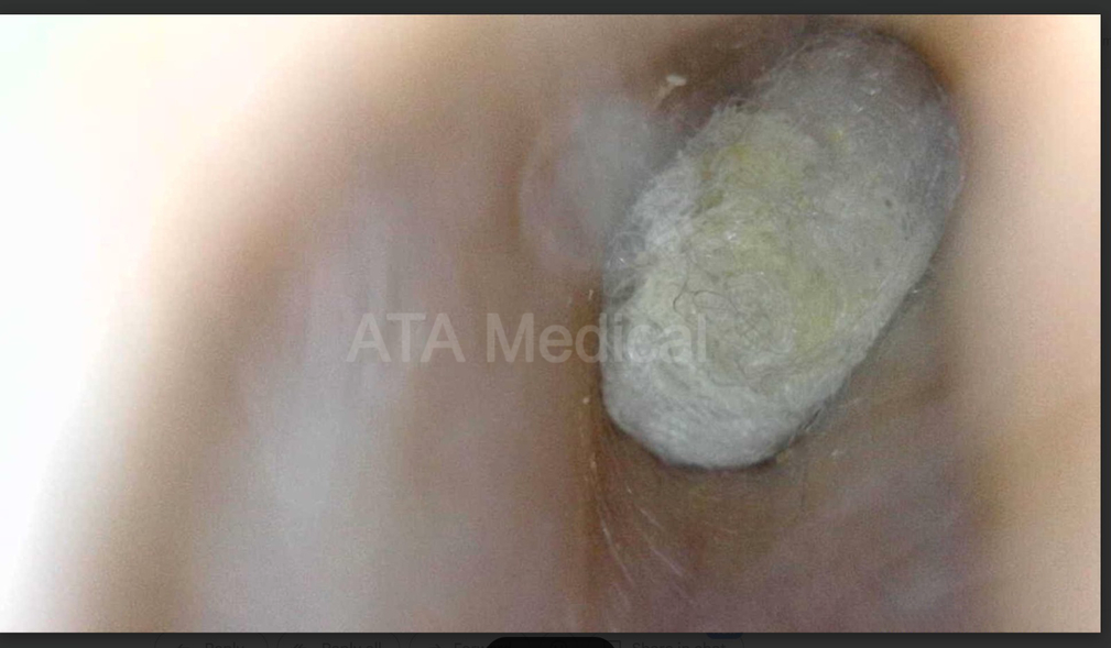 Otoscope view of cotton bud fibres trapped inside impacted ear wax pressed against the eardrum