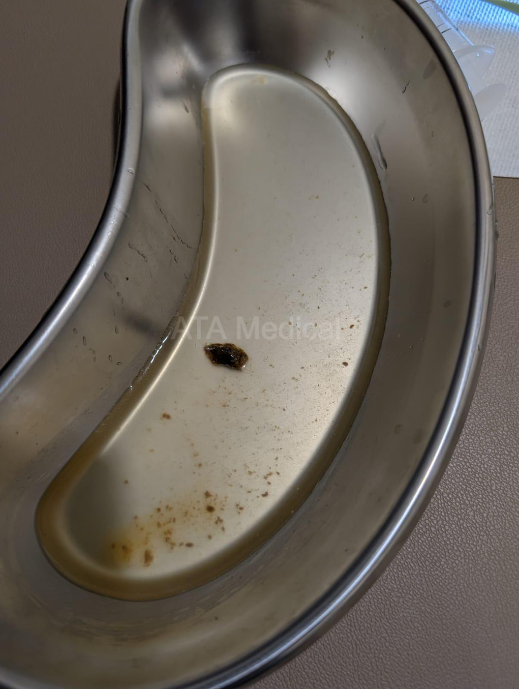 Extracted pieces of ear wax displayed in a stainless steel kidney dish after a professional ear wax removal procedure