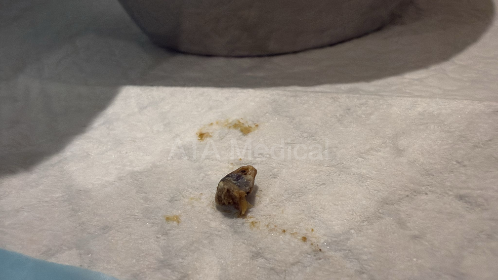 Pieces of ear wax removed during a professional ear wax removal procedure