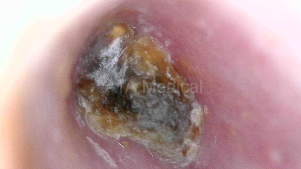 Otoscope view of impacted ear wax pressing against the eardrum